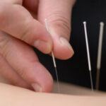 acupuncture