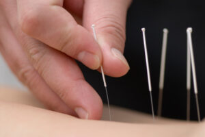 Acupuncture | Gold Living Acupuncture